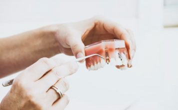 Implant sau punte dentară? Diferențe, caracteristici și avantaje Implant sau punte dentară? Diferențe, caracteristici și avantaje