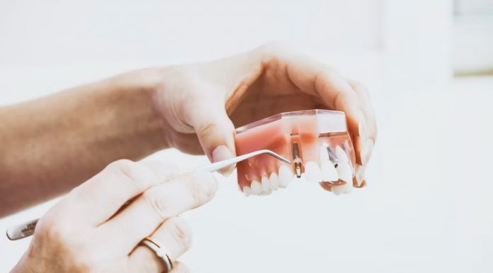 Implant sau punte dentară? Diferențe, caracteristici și avantaje Implant sau punte dentară? Diferențe, caracteristici și avantaje