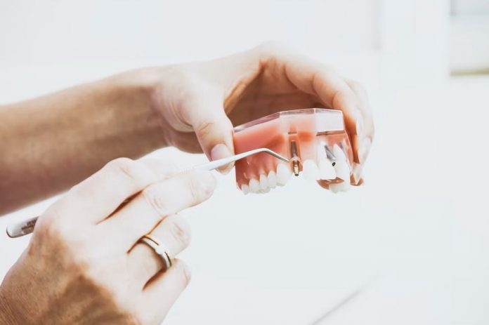 Implant sau punte dentară? Diferențe, caracteristici și avantaje